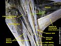 臂丛神经与腋动脉 (2)
