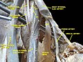 Lumbosacral plexus Deep dissection.