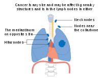 Stage IIIB lung cancer
