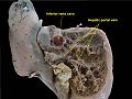 Hepatic portal vein. Plastination technique.