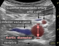 The standard aortic measurement on abdominal ultrasonography, such as used for abdominal aortic aneurysms, is between the outer margins of the aortic wall.[3]