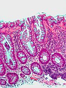 Microvesicular hyperplastic polyp. H&E stain.