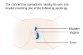 Stage 2 vulvar cancer