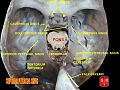 Superior petrosal sinus