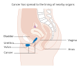 Stage 4A vulvar cancer