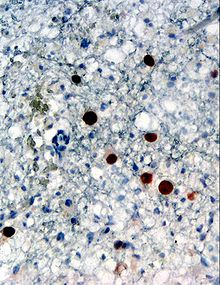 Immunohistochemical detection of "Human polyomavirus 2" protein (stained brown) in a brain biopsy (glia demonstrating progressive multifocal leukoencephalopathy (PML))