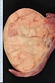 Gross pathology of seminoma