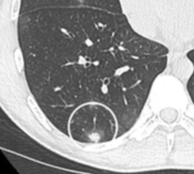 CT image showing halo sign in patient with pulmonary aspergillosis. Note ground-glass opacification surrounding the area of consolidation (circled).
