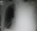 Massive left-sided pleural effusion (whiteness) in a patient presenting with lung cancer.