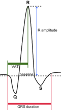 QRS complex