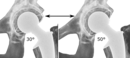 Acetabular inclination is normally between 30 and 50°.[88] A larger angle increases the risk of dislocation.[14]