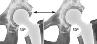 Range of acetabular inclination