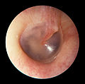 A normal human right tympanic membrane (eardrum)