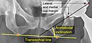 Acetabular inclination.[88] This parameter is calculated on an anteroposterior radiograph as the angle between a line through the lateral and medial margins of the acetabular cup and the transischial line which is tangential to the inferior margins of the ischium bones.[88]
