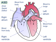 Diagram of the four chambers of the heart. There is a gap in the wall between the upper-left and upper-right chambers