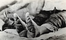 feet of a Chinese woman in an isolation hospital in Mauritius