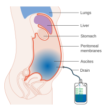 Diagram showing ascites being drained