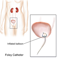 Foley Catheter Illustration