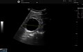 Renal cyst as seen on abdominal ultrasound