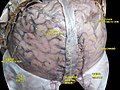 Meninges and superficial cerebral veins. Deep dissection. Superior view.
