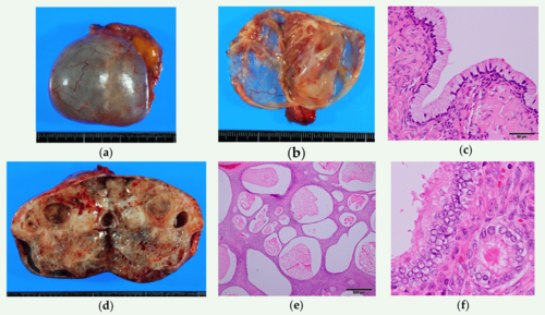 Squamous Ovarian Cell Carcinoma