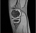 核磁共振（MRI）矢状面影像：膝关节面的高T2权重影像，可以看到在股骨内髁（英语：Medial condyle of femur）外侧有一个剥脱性骨软骨炎病灶。影像中的股骨内髁在T2讯号下呈现弥漫性的讯号增强，显示有骨髓水肿的情形。