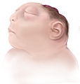 Illustration from the Centers for Disease Control and Prevention of Anencephaly.