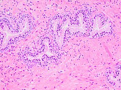 Histology of normal prostate, H&E stain, with benign features: Glands are rounded to irregularly branching, with an inner layer of epithelial cells surrounded by an outer layer of basal cells. They are surrounded by ample stroma.
