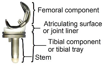 Main components of a knee prosthesis.