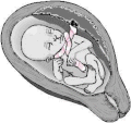 Nuchal cord - locked pattern[1]