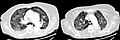 CT, 16 days after onset, showing extensive pulmonary parenchymal involvement consisting of irregular septal thickenings with ground-glass areas and centrilobular nodules with a peri-lymphatic distribution.