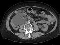 Massive hydronephrosis as marked by the arrow.