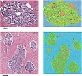 Breast lobules. - By: de Bel T, Litjens G, Ogony J, Stallings-Mann M, Carter JM, Hilton T (Attribution 4.0 International License)