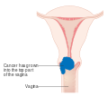 Stage 2A cervical cancer