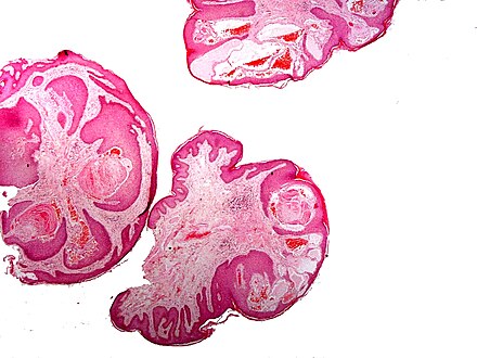 Scrotal angiokeratoma (Fordyce type); multiple papules made by dilatated capillaries