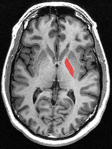 Transverse section of the globus pallidus from a structural MR image.