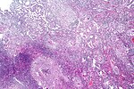 Pulmonary tuberculosis characterized by granulomatous inflammation with necrotizing epithelioid granulomas. Low power view. H&E stain.