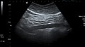 Abdominal aorta ultrasound