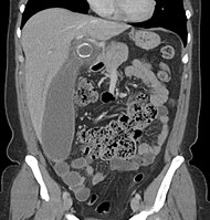 Cholecystitis