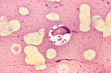 "Leishmania donovani" in bone marrow cell