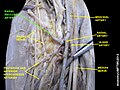 Radial recurrent artery