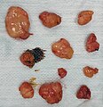 A collection of small lipomas removed from the arms of a patient
