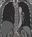 Several congenital block vertebrae in the transition from the thoracic to the lumbar spine and hemivertebrae.