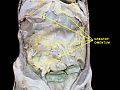 Greater omentum. Deep dissection.