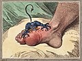 Gout was historically known as "the disease of kings" or "rich man's disease"[3][8] and has been recognized since at least the time of the ancient Egyptians.[3]