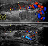 Doppler ultrasound of epididymitis, seen as a substantial increase in blood flow in the left epididymis (top image), while it is normal in the right (bottom image). The thickness of the epididymis (between yellow crosses) is only slightly increased (7 mm).