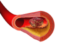Illustration depicting thrombus formation over arterial plaque.