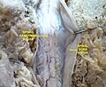 脊柱硬脑膜打开，可见蛛网膜。