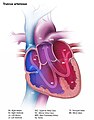 Persistent (or patent) truncus arteriosus