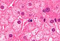 毛玻璃樣肝細胞的顯微鏡圖，H&E染色。
